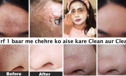 ऐसे करे चेहरे का Clean Up-सिर्फ 2 use में Whiteheads-Bumps-Blackhead-acne होंगे साफ़-म…